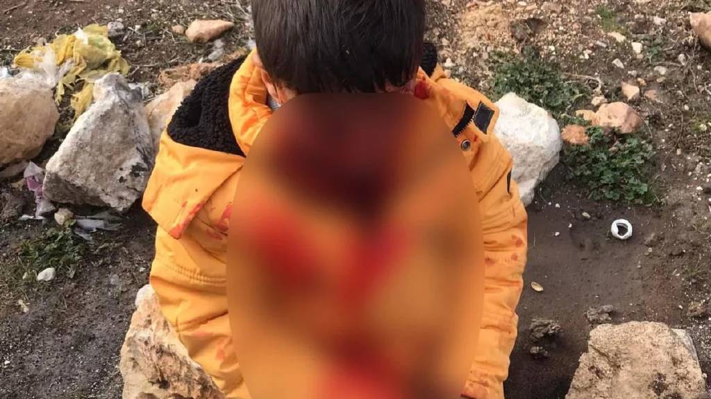 Başıboş köpeğin saldırdığı 6 yaşındaki çocuğun son durumu
