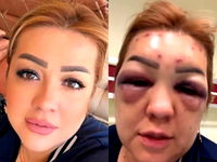 Botoks bu hale getirdi! ‘Doktor harici kimseye yaptırmayın’