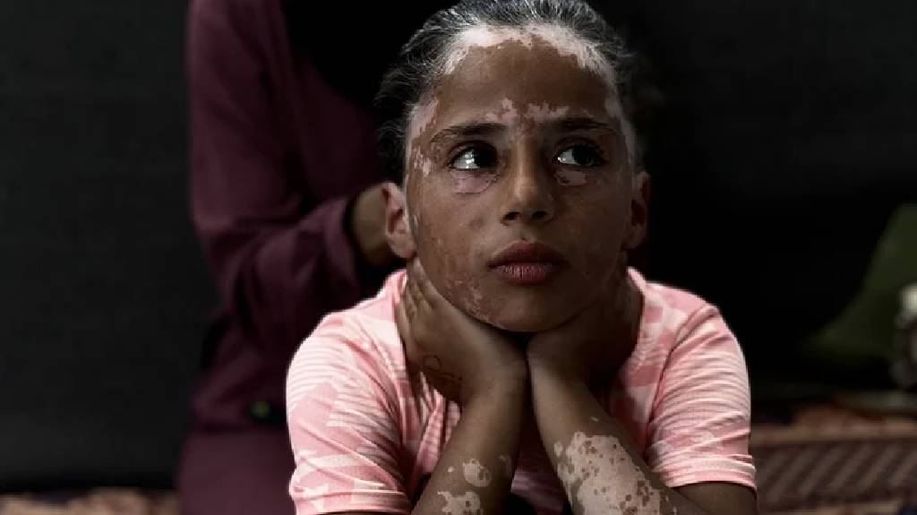 İsrail korkusu yüzünden vitiligo hastalığına yakalandı