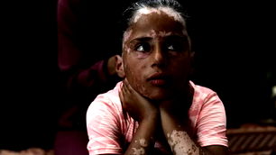 İsrail korkusu yüzünden vitiligo hastalığına yakalandı