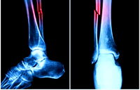 Üç dakikada kırık tedavisi: Çin'den yeni "kemik yapıştırıcısı" projesi